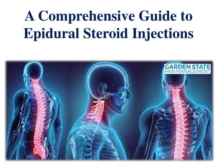 a comprehensive guide to epidural steroid