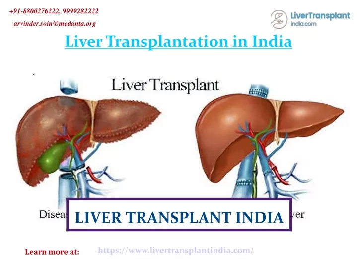 PPT - The Best Liver Transplantation in India PowerPoint Presentation ...