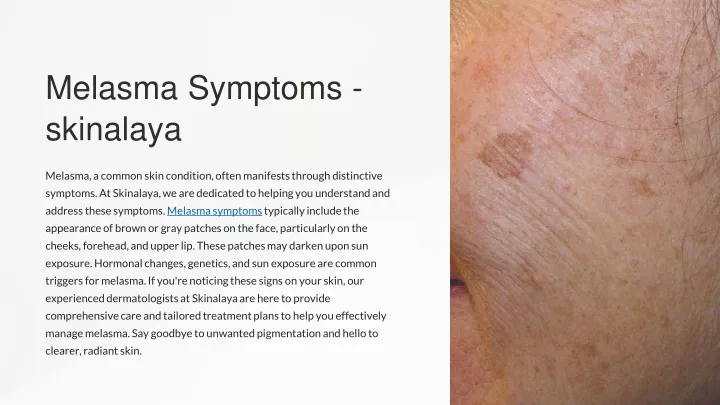 melasma symptoms skinalaya