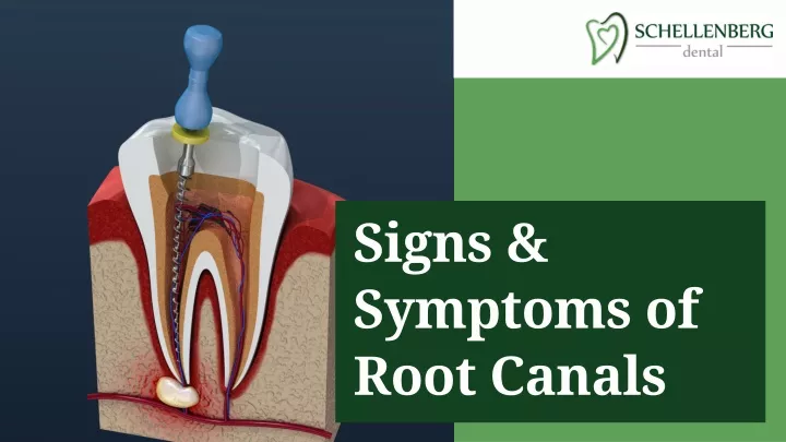 signs symptoms of root canals
