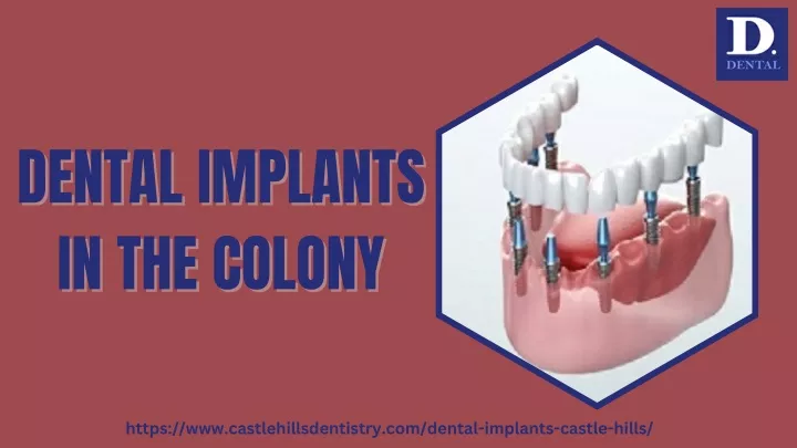 dental implants in the colony