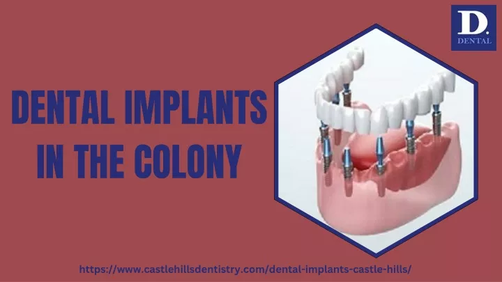 dental implants in the colony