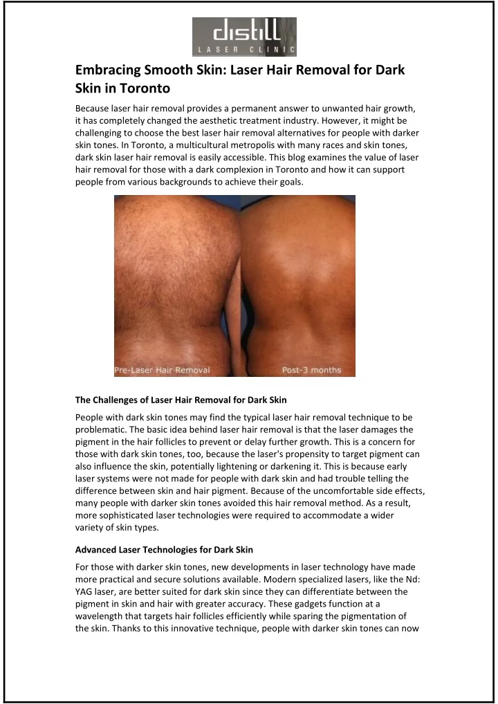 embracing smooth skin laser hair removal for dark