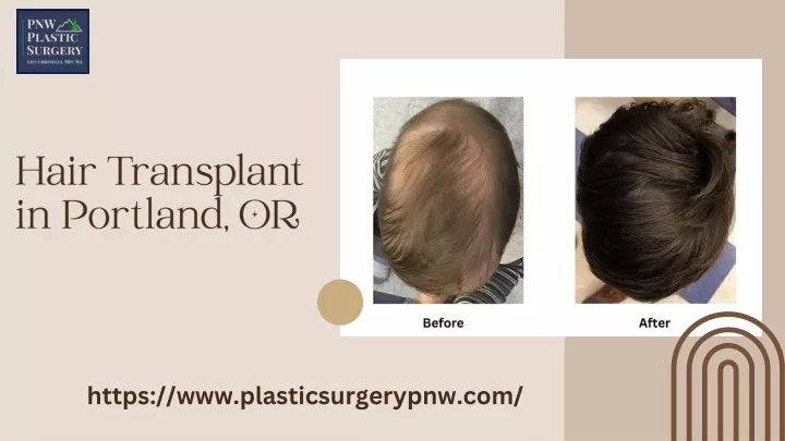 hair transplant in portland or