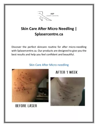 Skin Care After Micro Needling | Splasercentre.ca