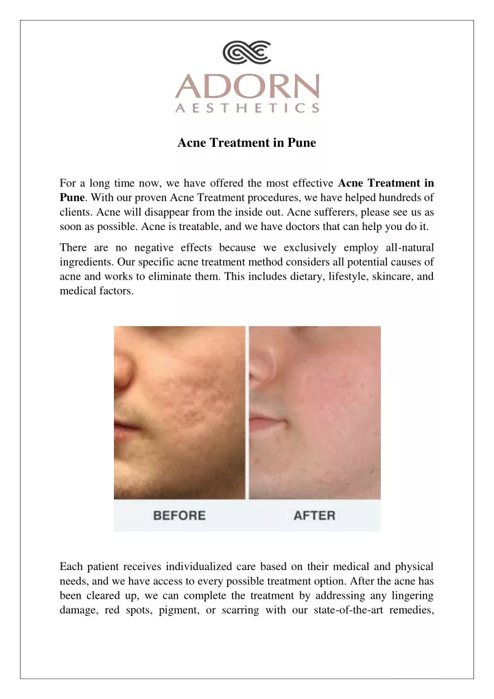 acne treatment in pune