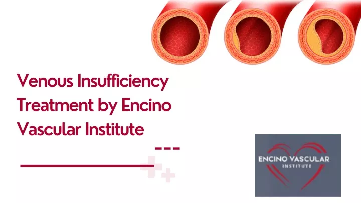 venous insufficiency treatment by encino vascular