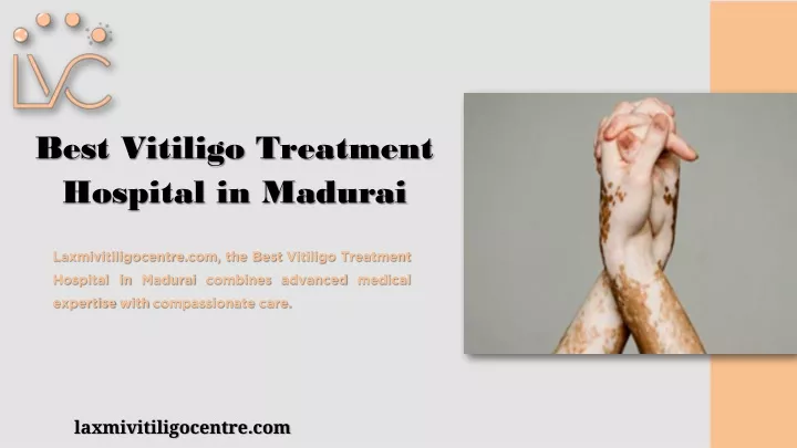 best vitiligo treatment hospital in madurai