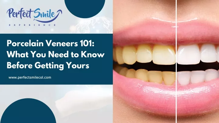 porcelain veneers 101 what you need to know