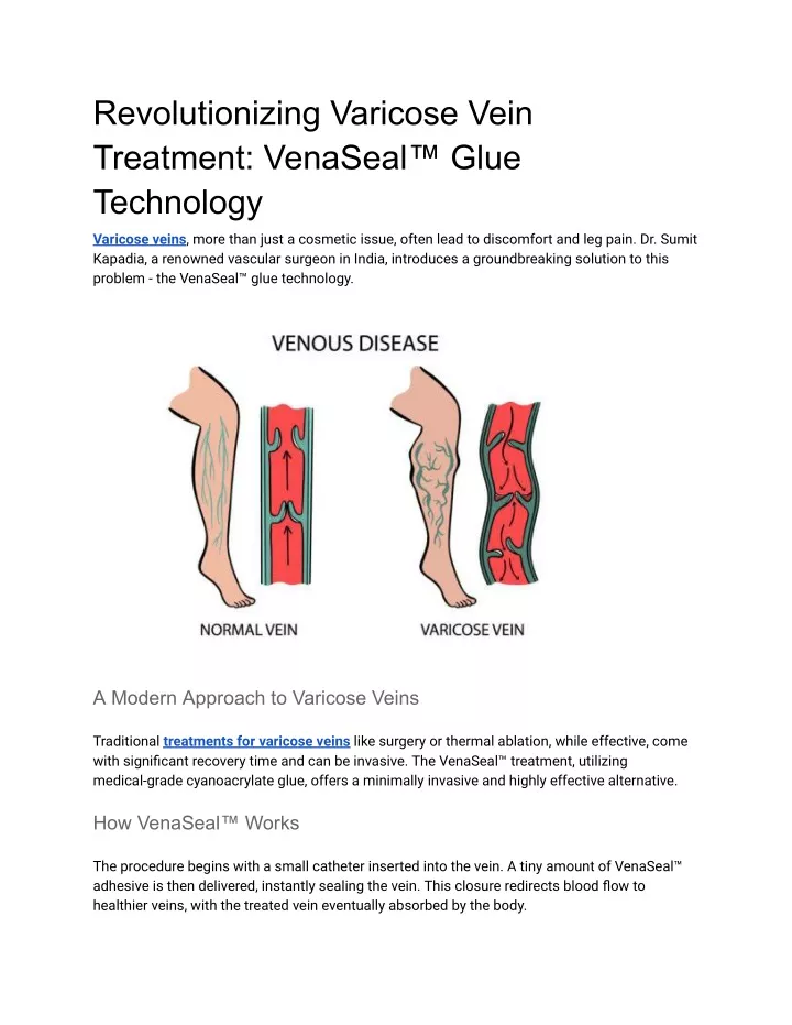 revolutionizing varicose vein treatment venaseal