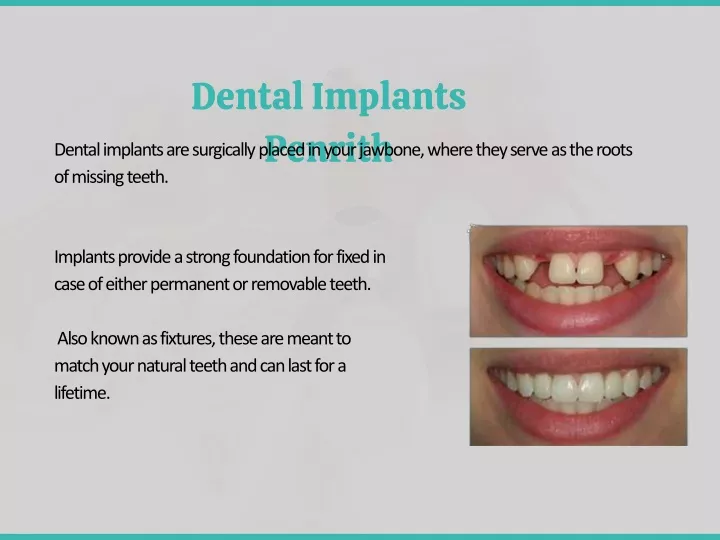 dental implants penrith