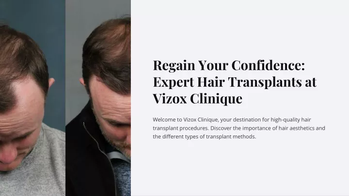 regain your confidence expert hair transplants