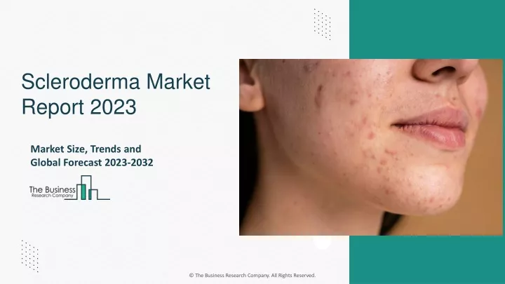 scleroderma market report 2023