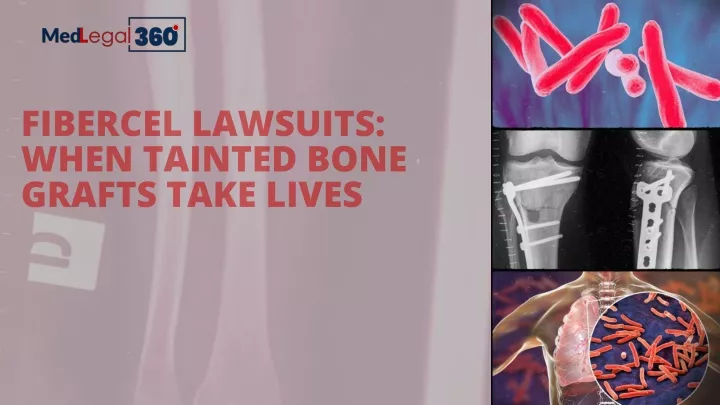 fibercel lawsuits when tainted bone grafts take