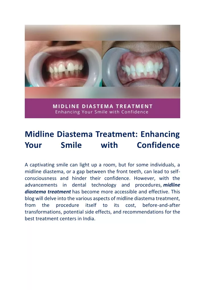 midline diastema treatment enhancing your smile