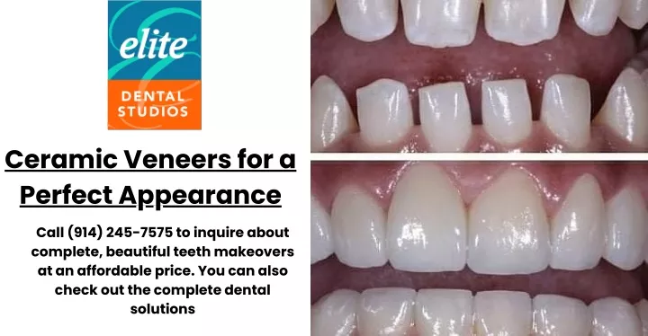 ceramic veneers for a perfect appearance