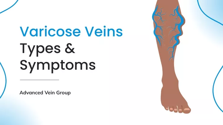 varicose veins types symptoms