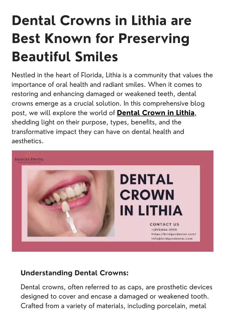 dental crowns in lithia are best known