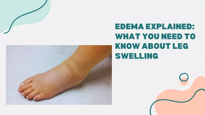 edema explained what you need to know about