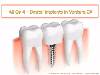 All On 4 – Dental Implants in ventura CA