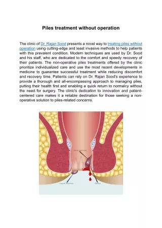 Piles treatment without operation