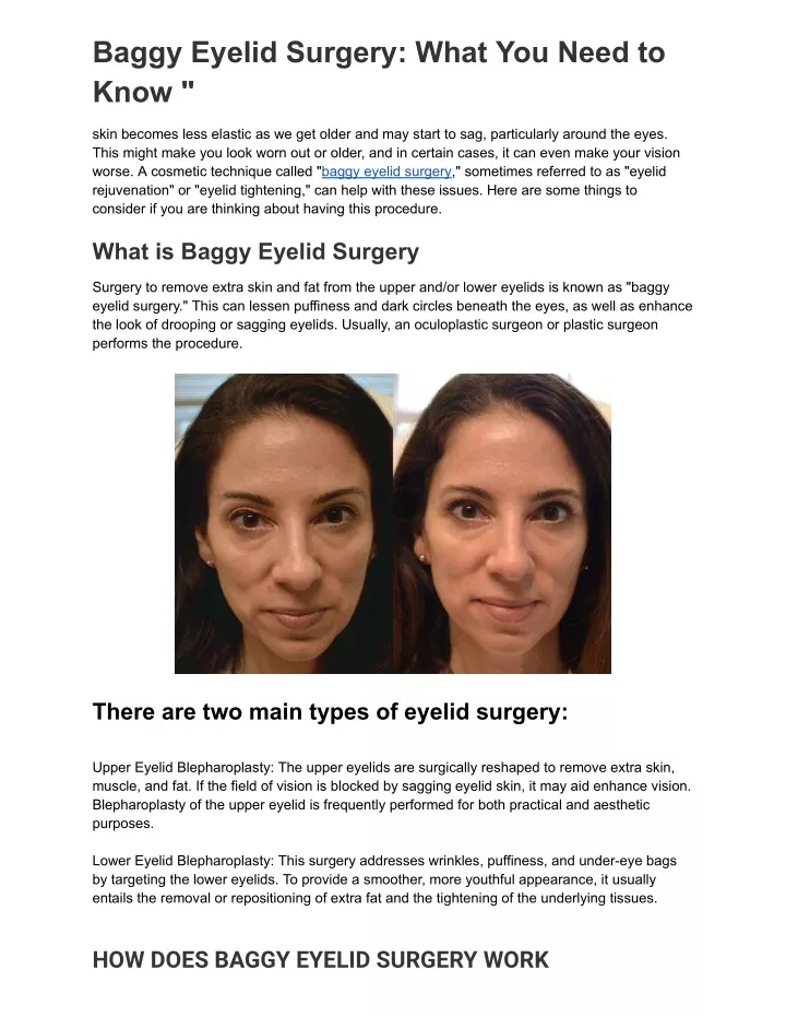 baggy eyelid surgery what you need to know