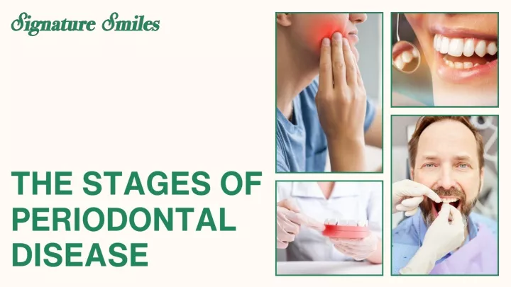 the stages of periodontal disease