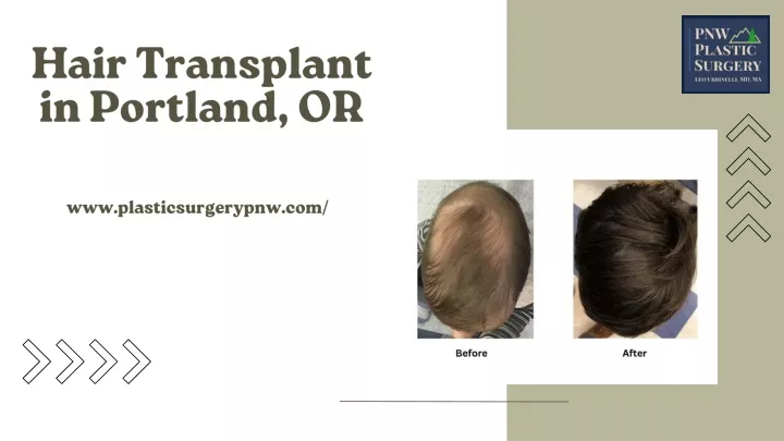 hair transplant in portland or