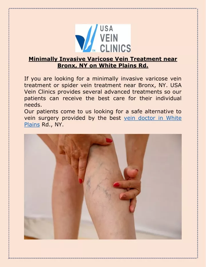 minimally invasive varicose vein treatment near
