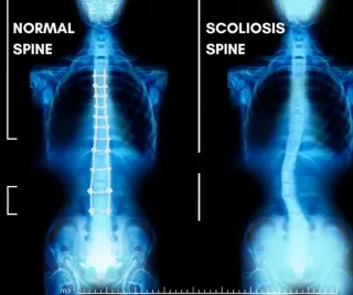 Scoliosis and Deformity Correction | Centre for Brain and Spine