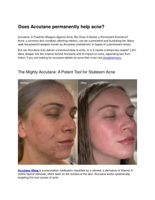 Does Accutane permanently help acne?