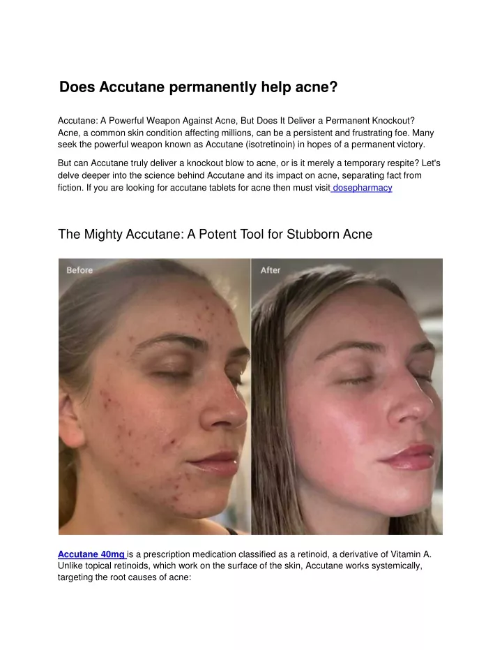 does accutane permanently help acne