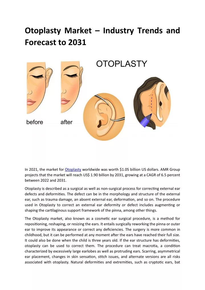 otoplasty market industry trends and forecast