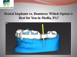 Dental Implants vs. Dentures Which Option is Best for You in Media, PA