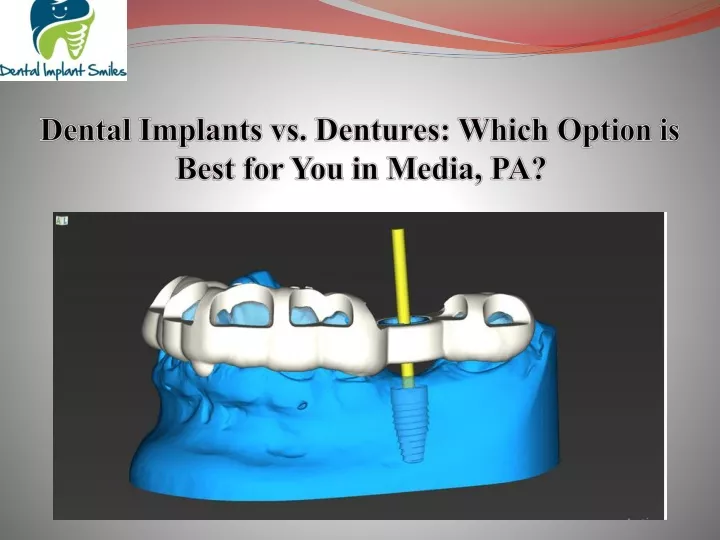dental implants vs dentures which option is best