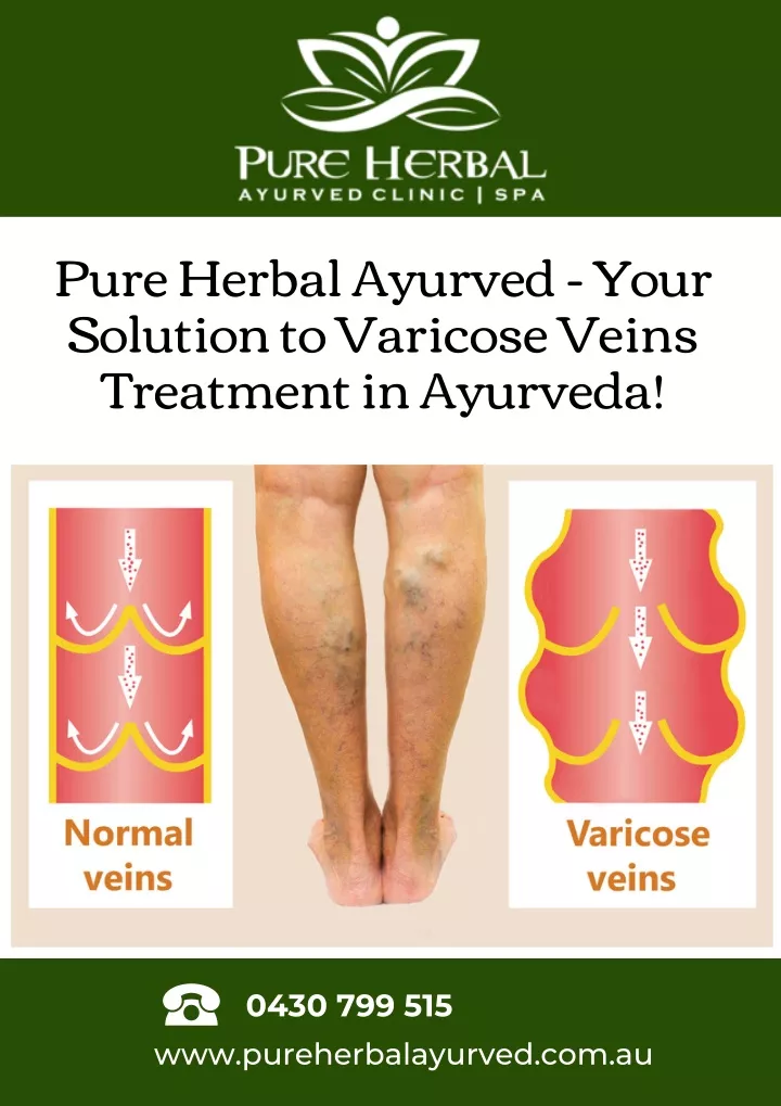 pure herbal ayurved your solution to varicose