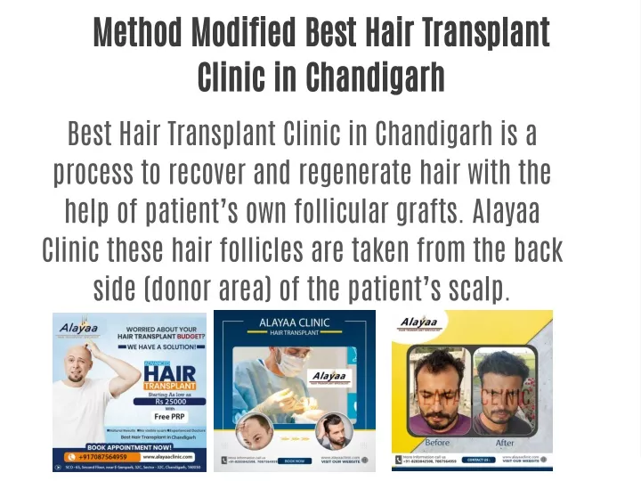 method modified best hair transplant clinic