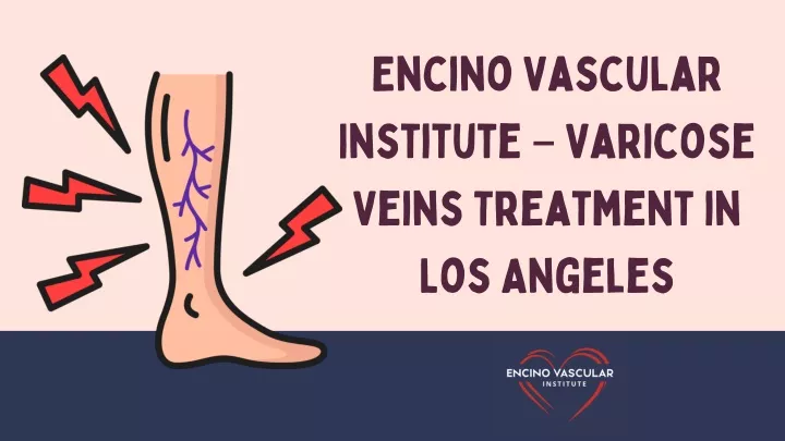 encino vascular institute varicose veins