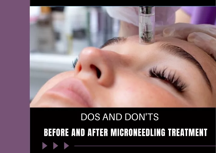 dos and don ts before and after microneedling