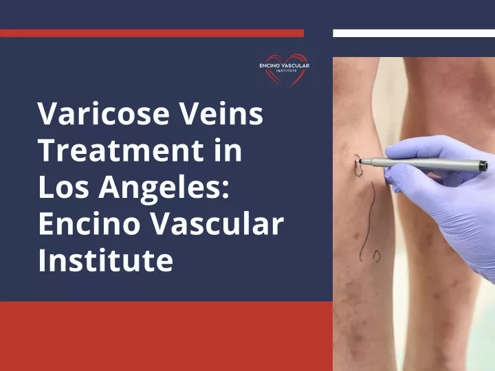 varicose veins treatment in los angeles encino