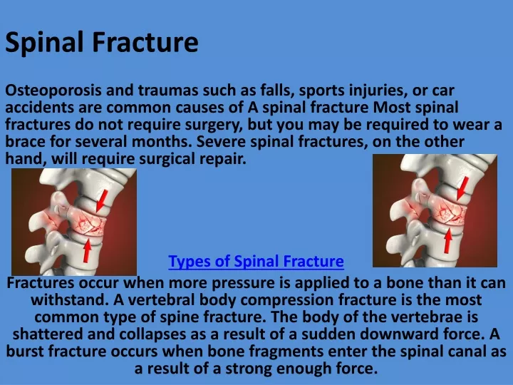 spinal fracture