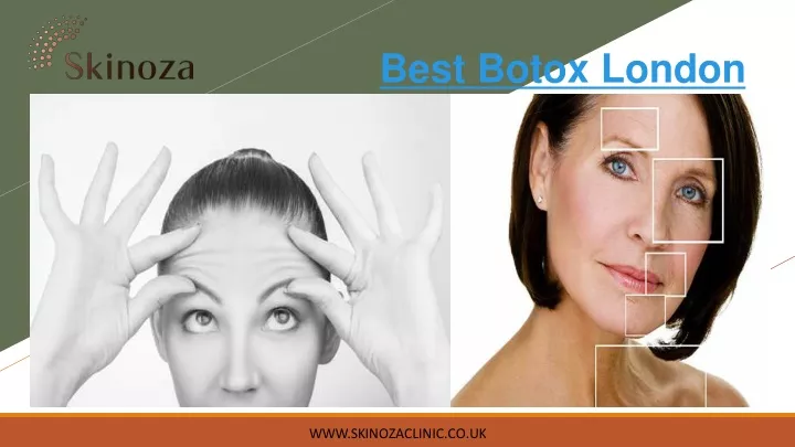 best botox london