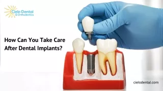 How Can You Take Care After Dental Implants