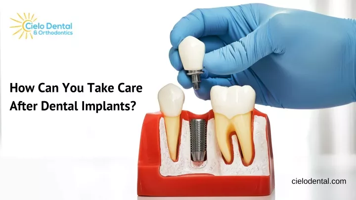how can you take care after dental implants