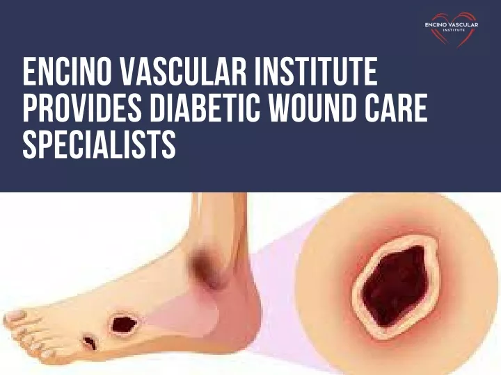 encino vascular institute provides diabetic wound