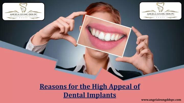 reasons for the high appeal of dental implants