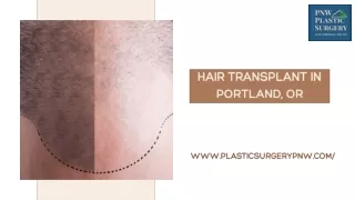 Get Confidence Back with Hair Transplant Services in Portland, OR