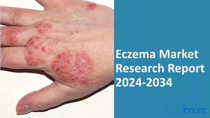 eczema market research report 2024 2034