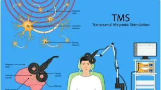 Accelerated TMS Moving Quickly into the Future of Depression Treatment (1)