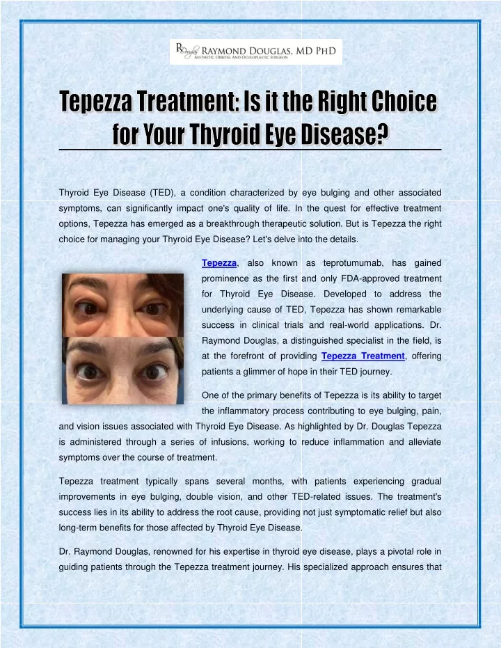 thyroid eye disease ted a condition characterized